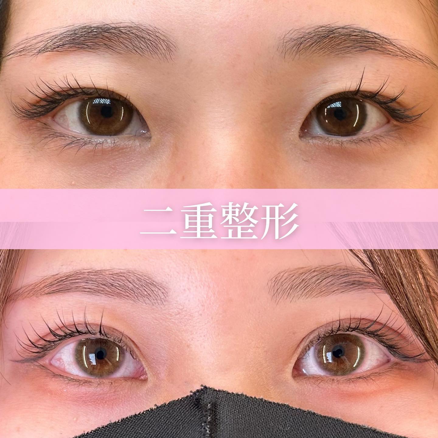 埋没法の術前と１か月後の症例写真