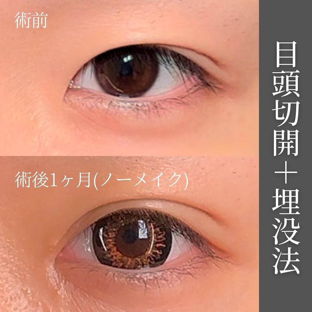 目頭切開と埋没法の術前と１か月後のノーメイクの症例写真