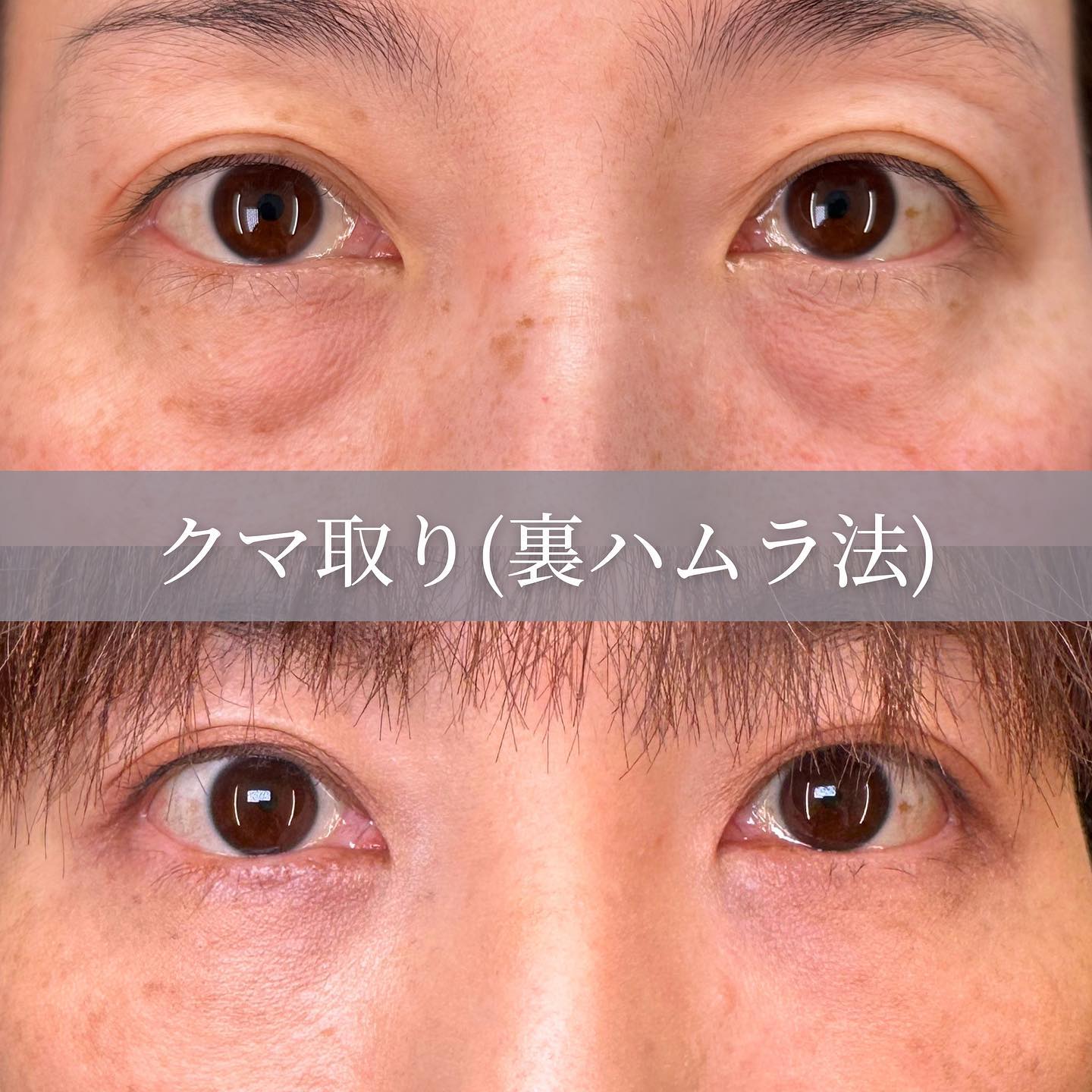 裏ハムラ法の術前と１か月後の症例写真