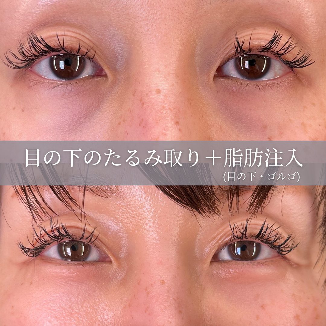 目の下のたるみ取りと脂肪注入の術前と１か月後の症例写真