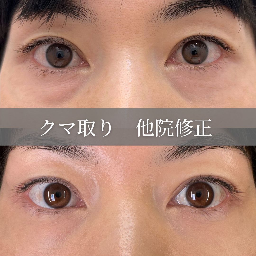 クマ取りの他院修正も術前と１か月後の症例写真