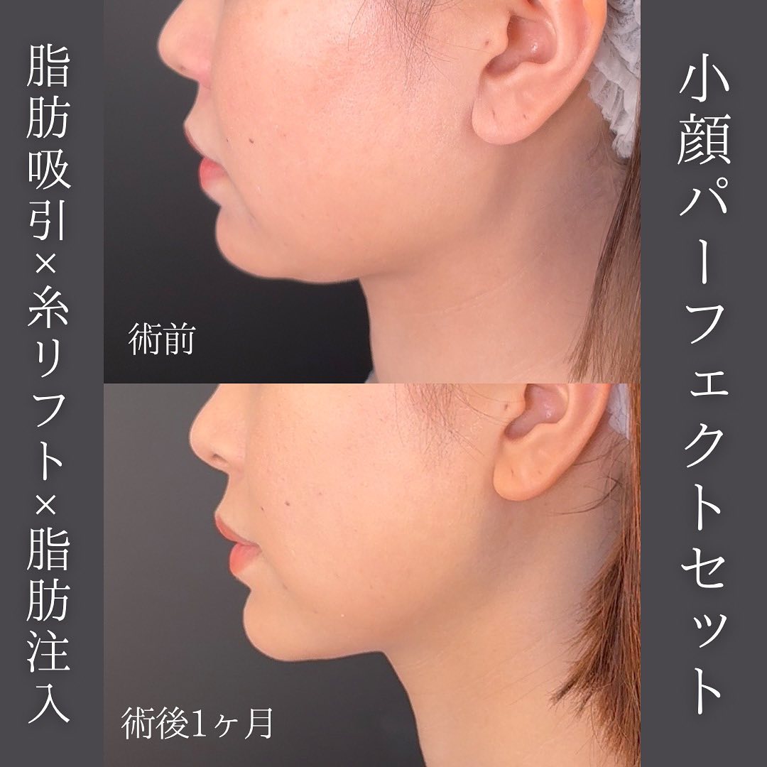 脂肪吸引と糸リフトと脂肪注入の手術前と１か月後の症例写真