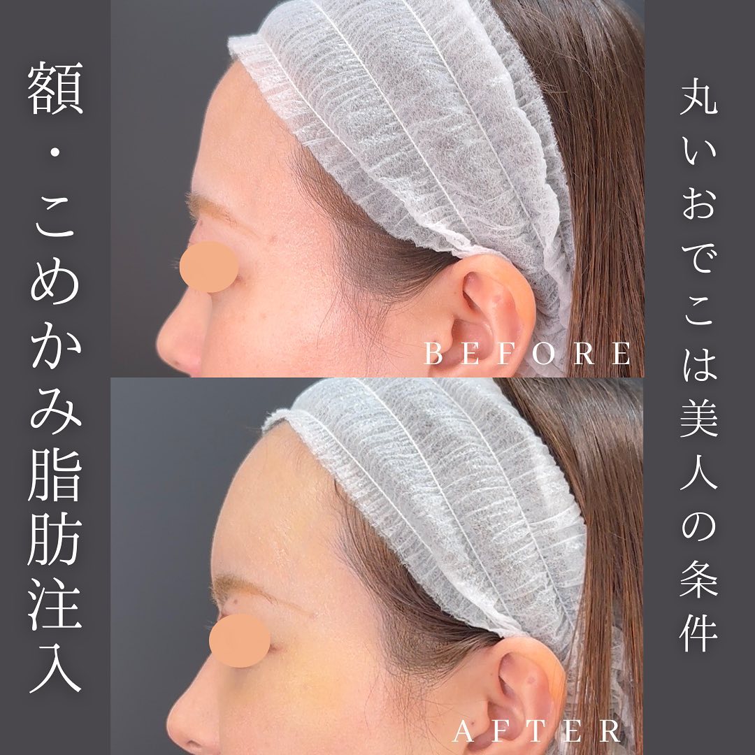 額とこめかみに脂肪注入した術前と１か月後の症例写真