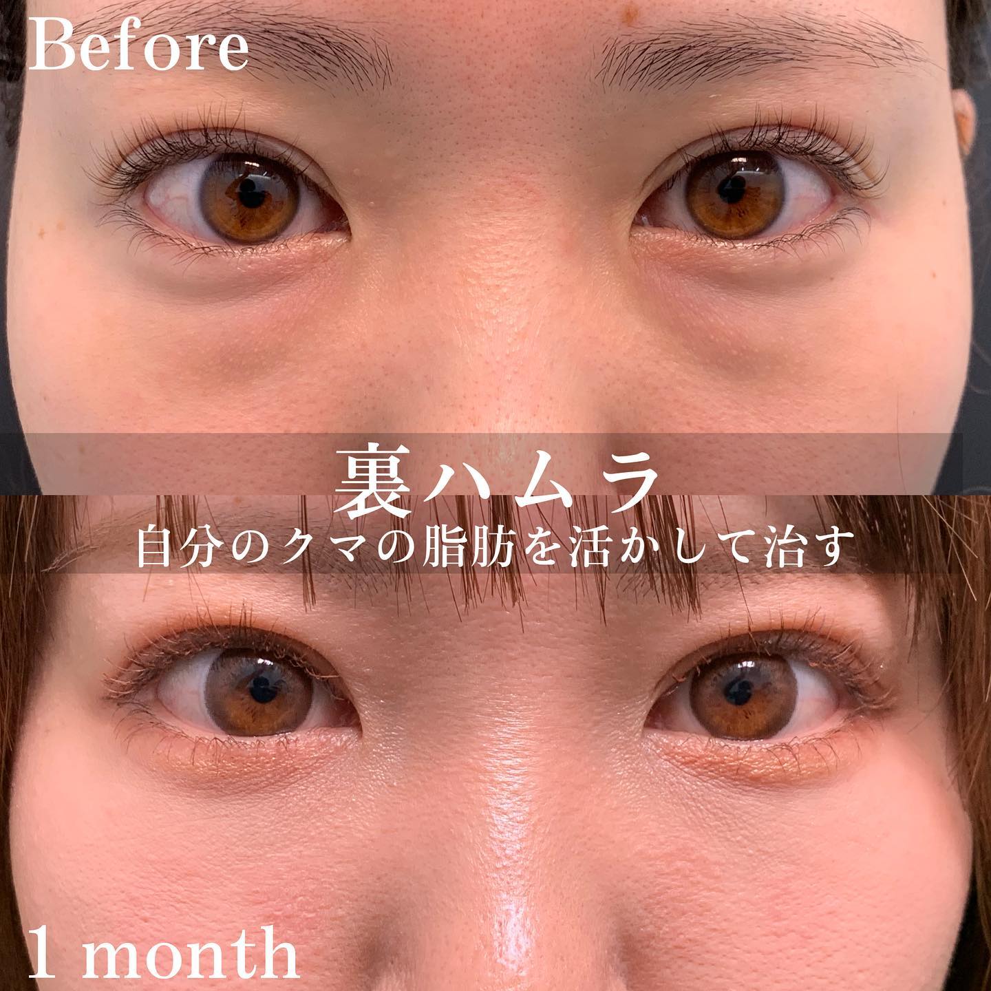 裏ハムラ法の症例写真