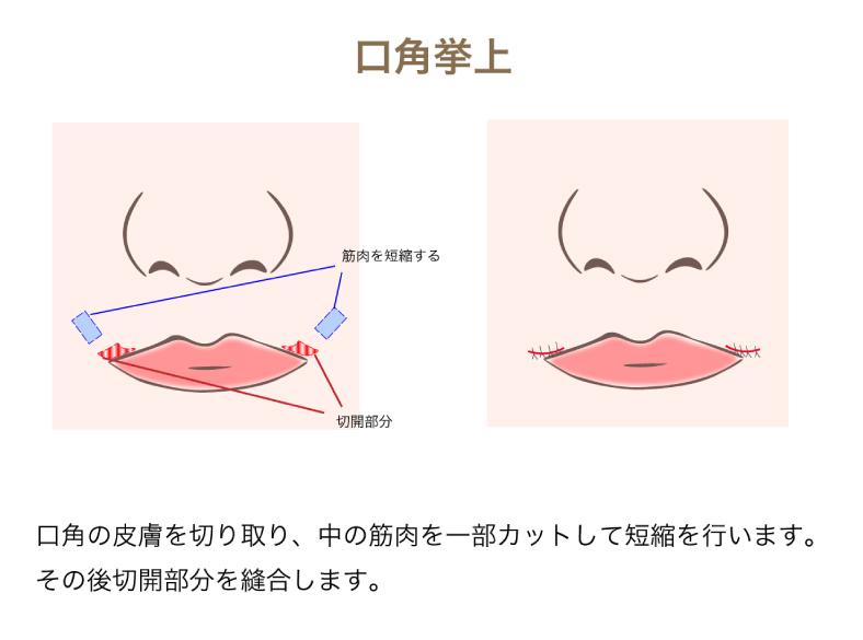 口角挙上