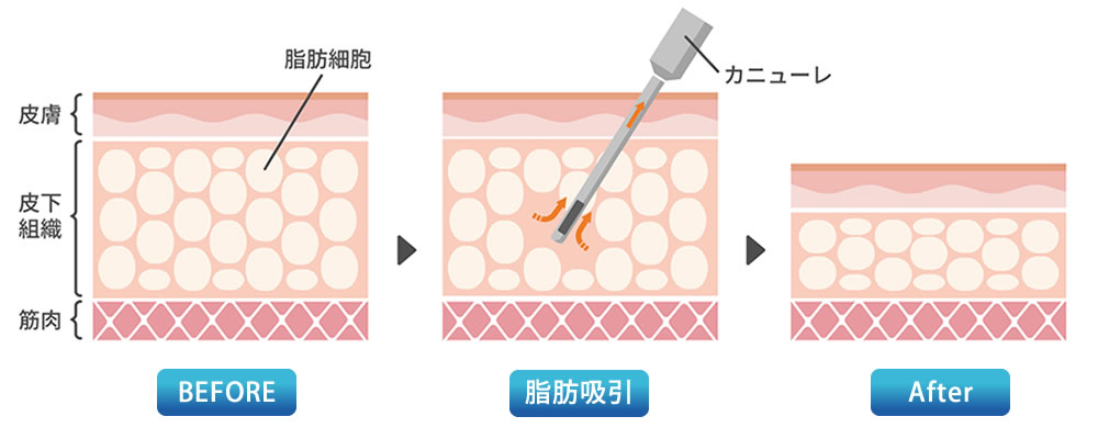 脂肪吸引解説