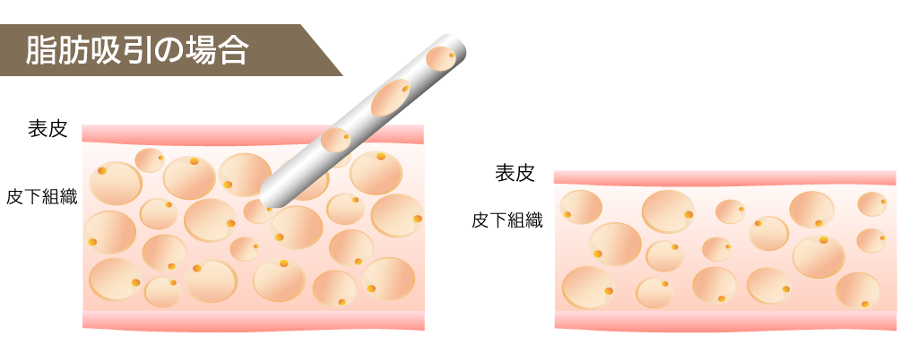 脂肪吸引