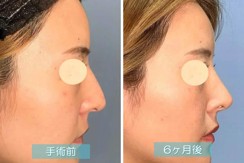 鷲鼻修正ハンプ切除術の症例写真
