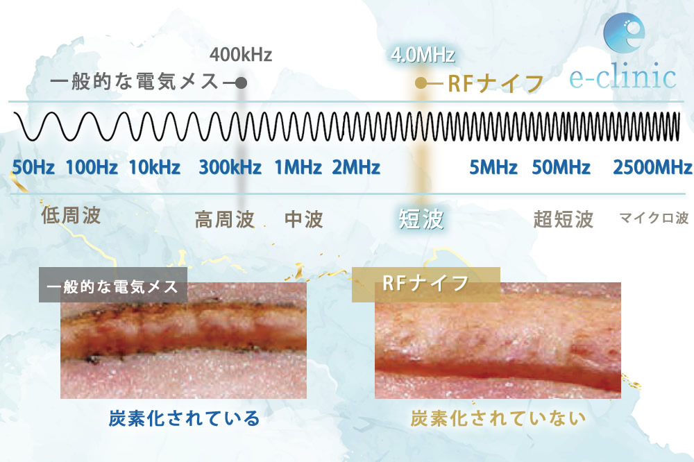 RFナイフの波長の説明