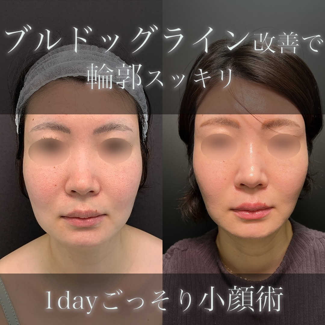 小顔の脂肪吸引の症例写真