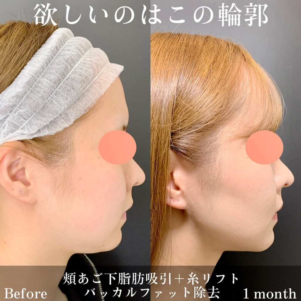 頬と顎下の脂肪吸引とバッカルファット所挙の１か月後の症例写真
