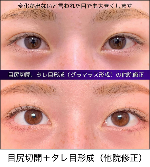 目尻切開＋タレ目形成（他院修正）