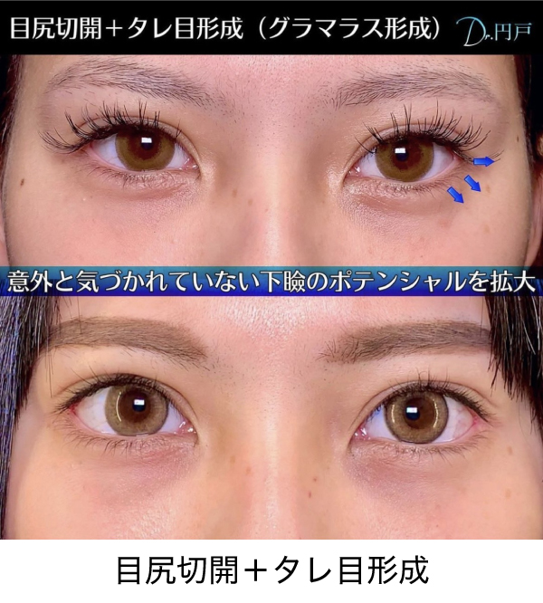 目尻切開＋タレ目形成の症例
