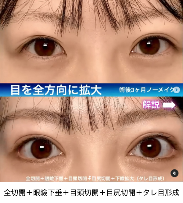 全切開＋眼瞼下垂＋目頭切開＋目尻切開＋タレ目形成