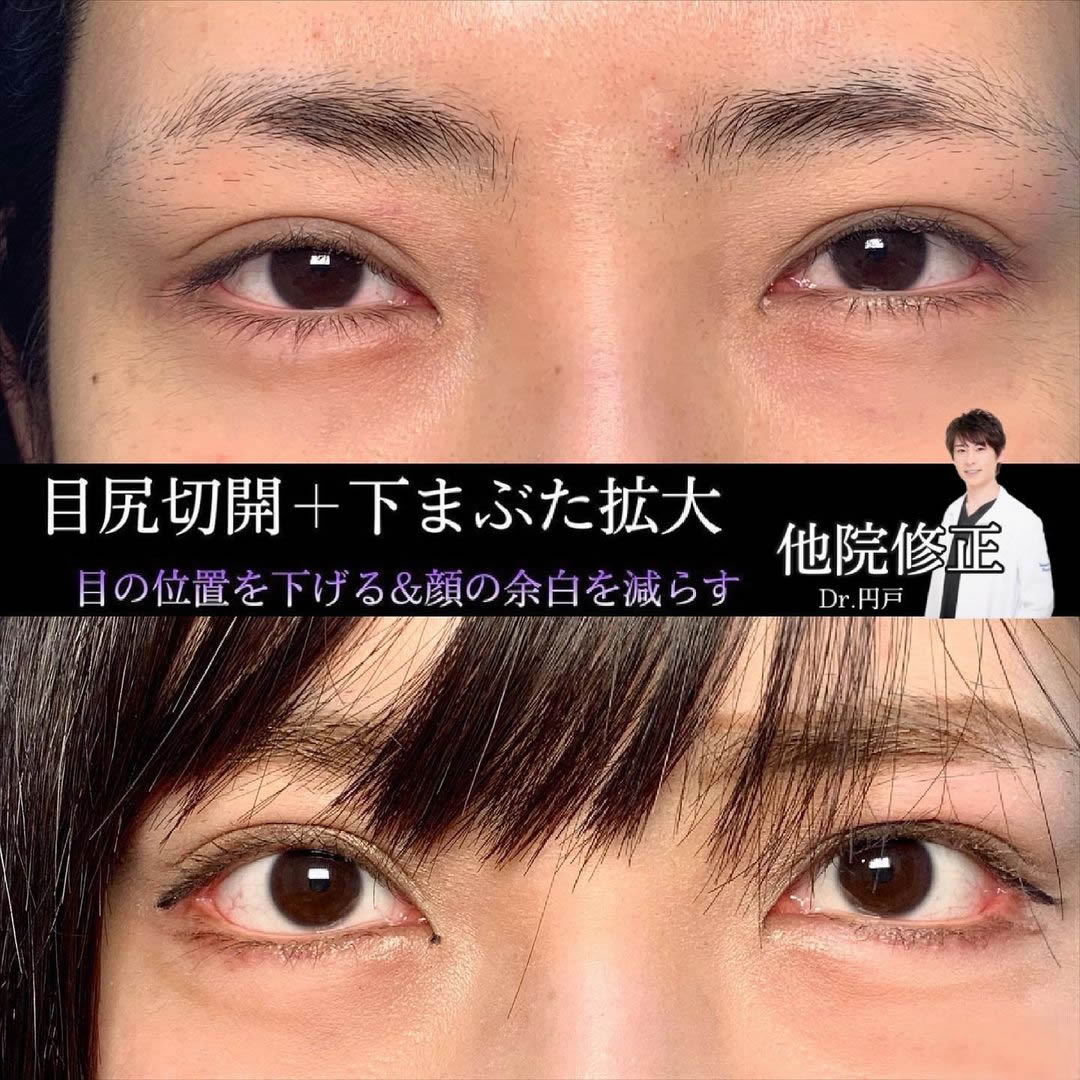 目尻切開の他院修正の用例１