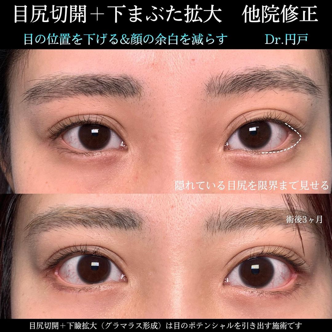 目尻切開の他院修正の用例2