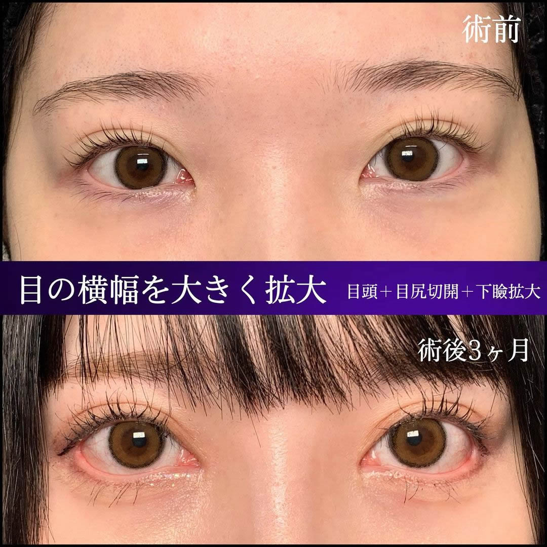 目尻切開で目の横幅を大きく拡大した症例