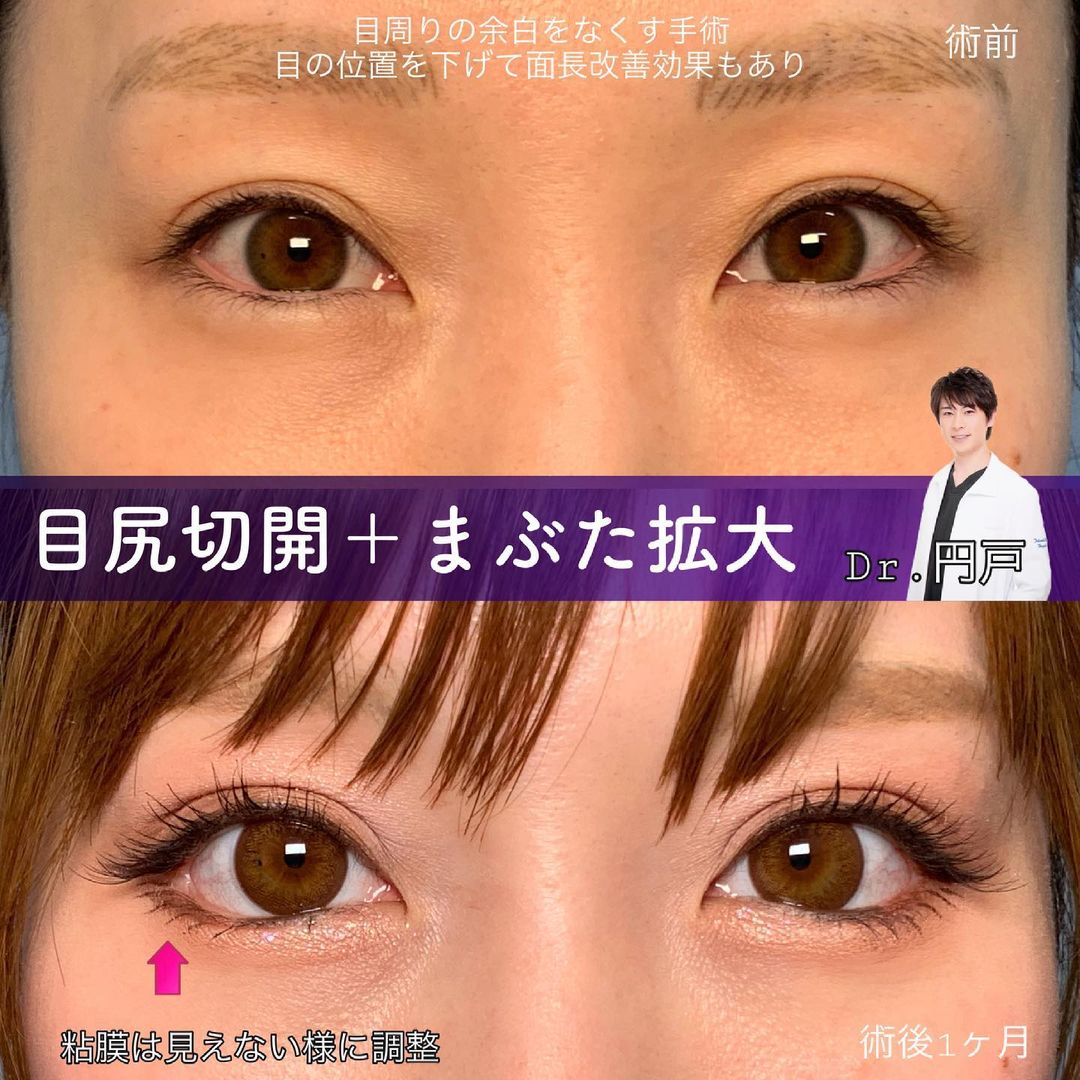 目尻切開によって目周りの余白を無くした２ヶ月後の症例写真