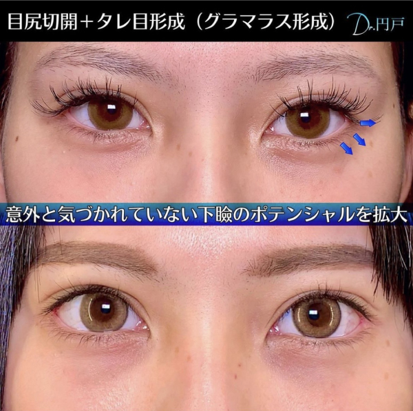 目尻切開＋タレ目形成