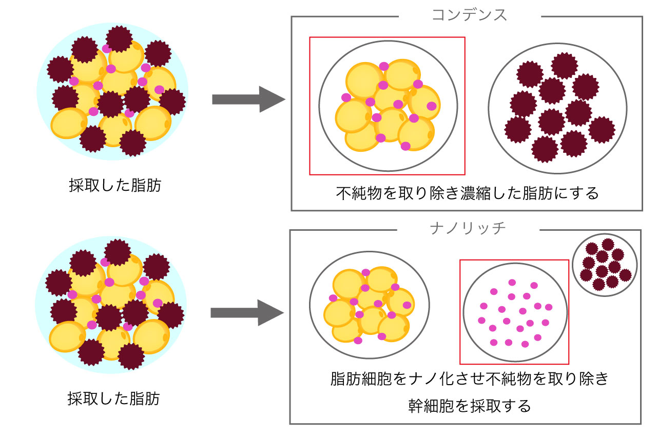 ナノリッチ脂肪注入