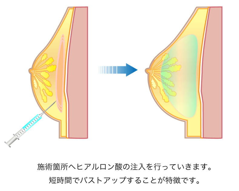 ヒアルロン酸豊胸