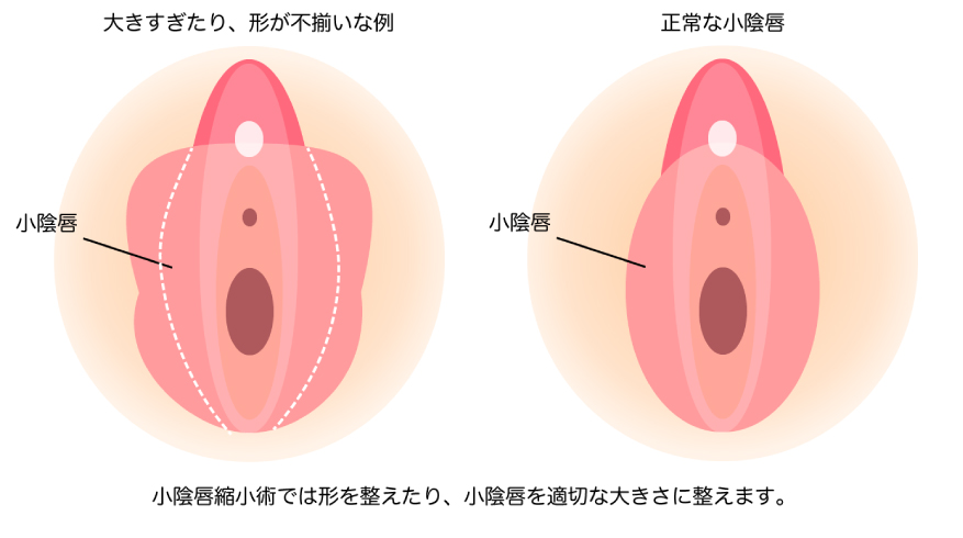 小陰唇