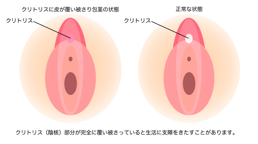 小陰唇