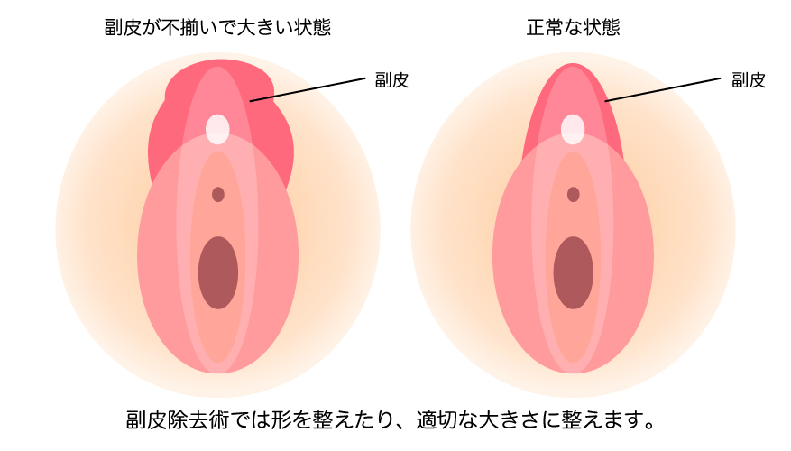 副皮除去術