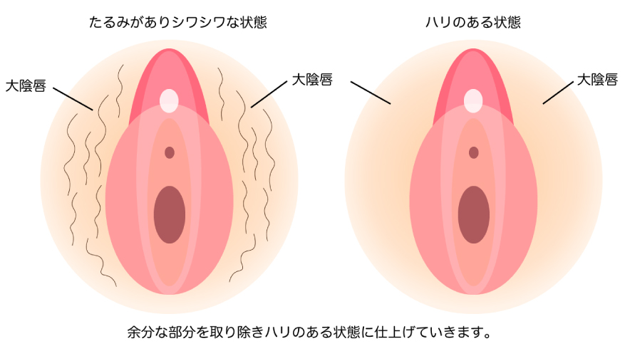 大陰唇たるみ取り