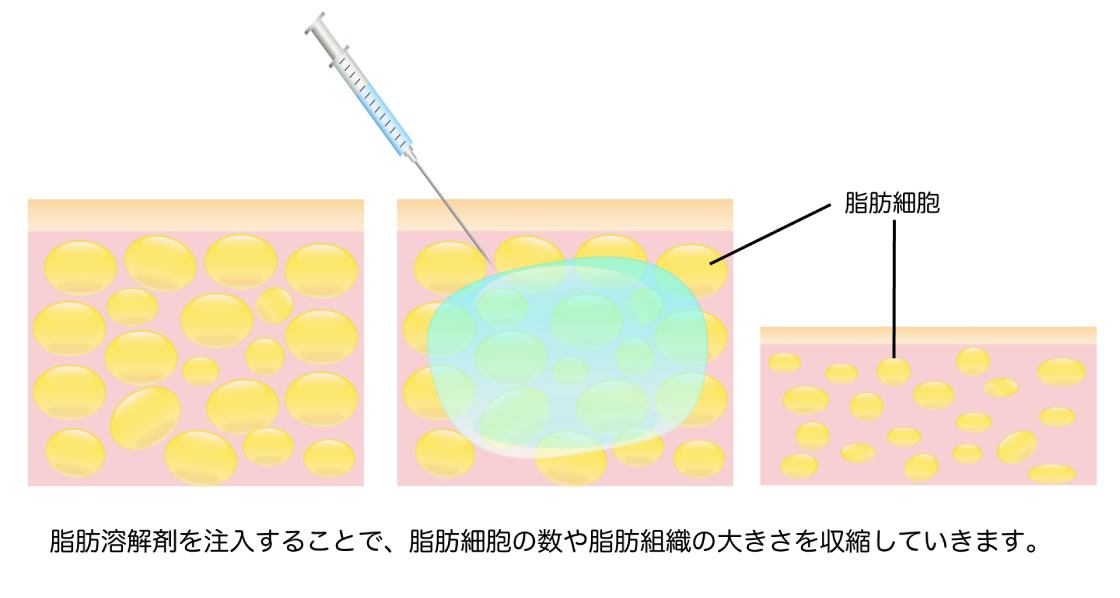 脂肪溶解注射