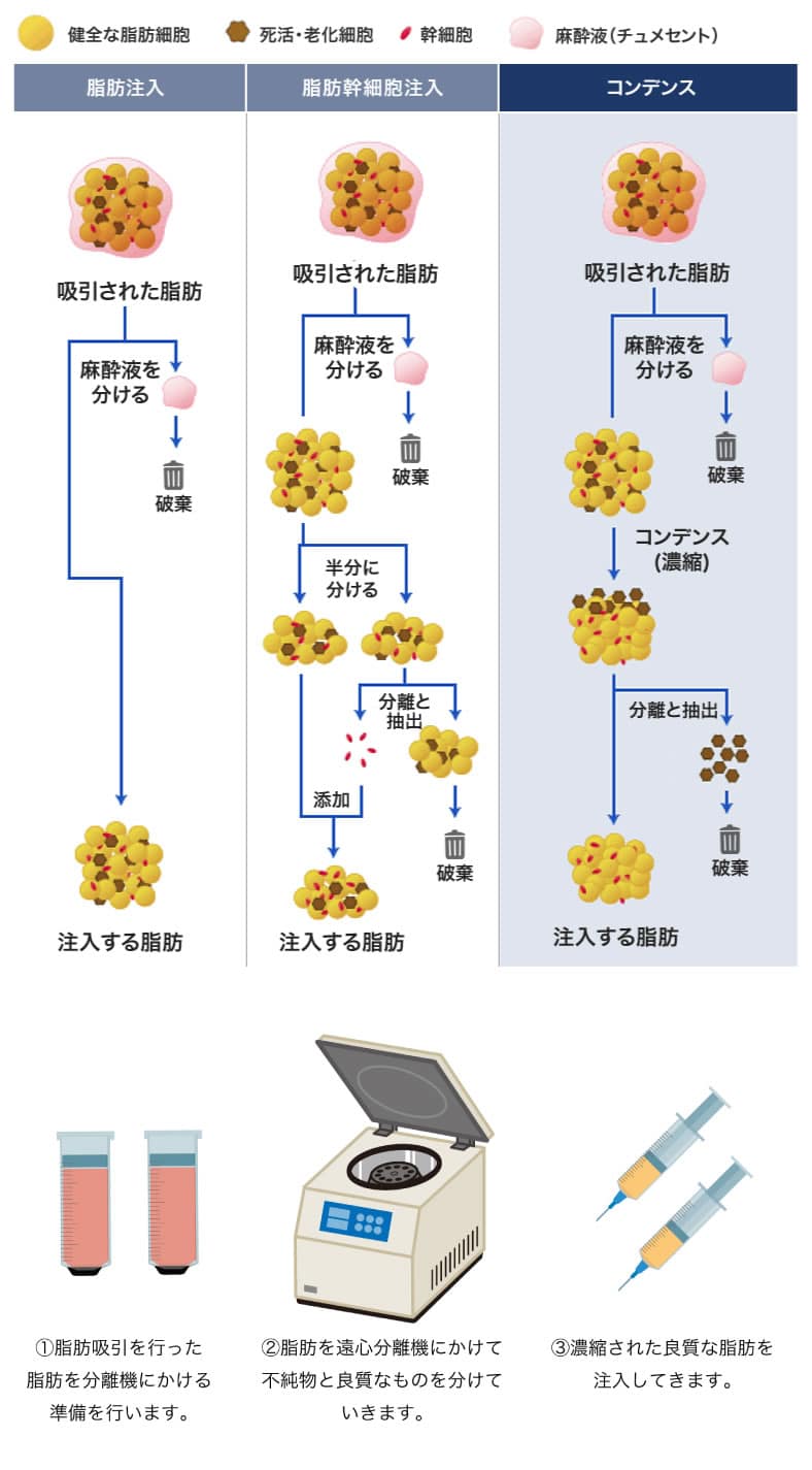 コンデンス法での豊胸