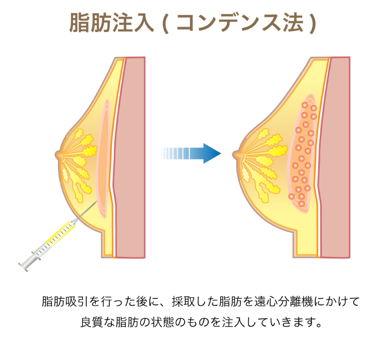 コンデンス法での豊胸