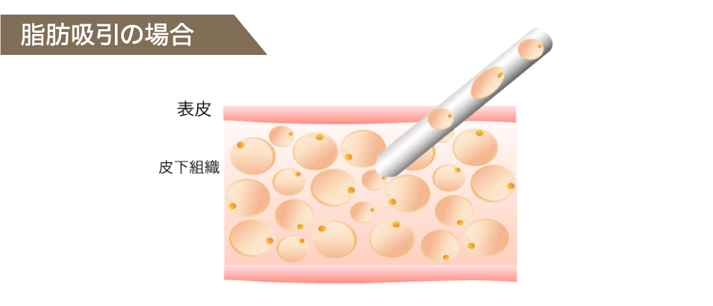 脂肪吸引