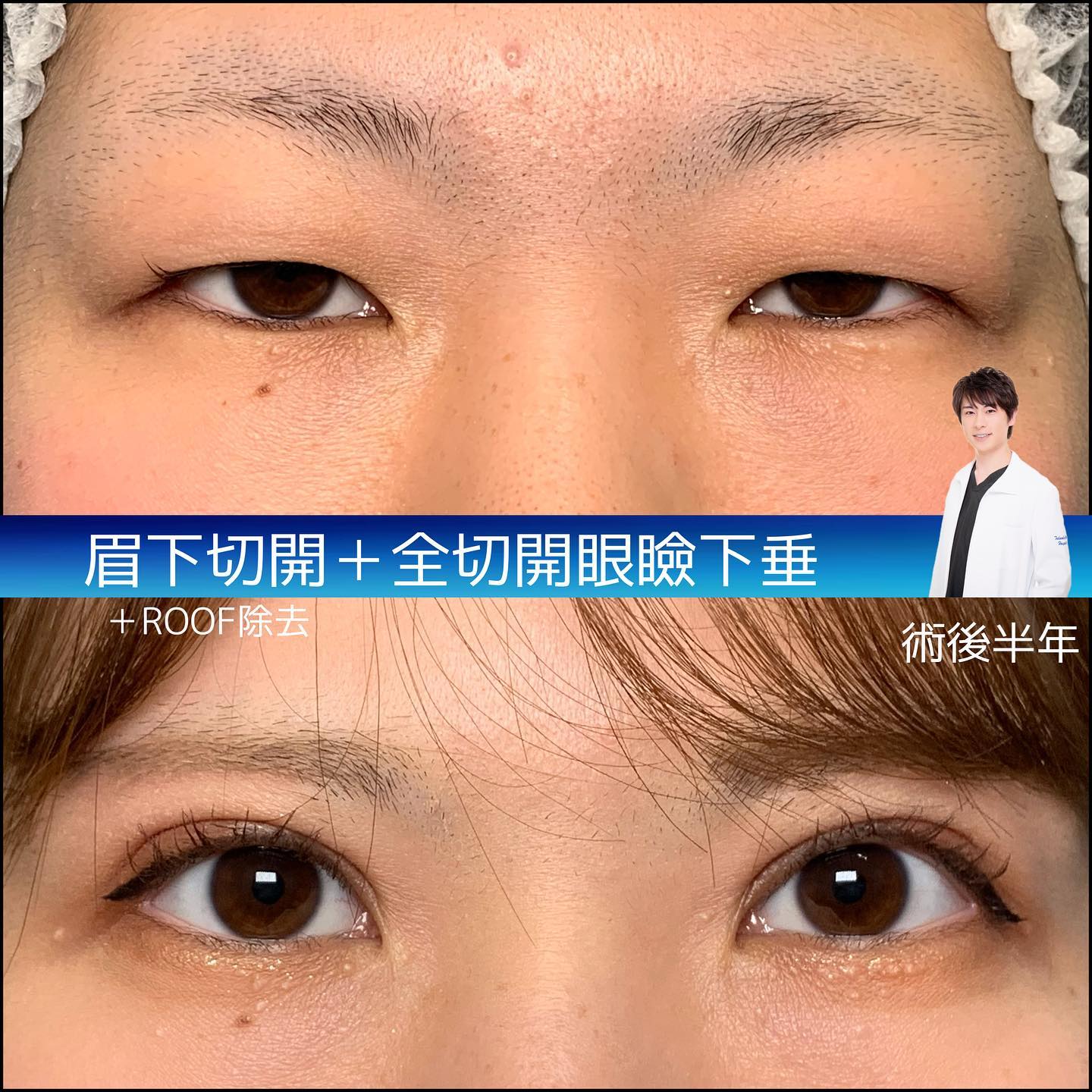 全切開と眉下切開を併用した症例写真