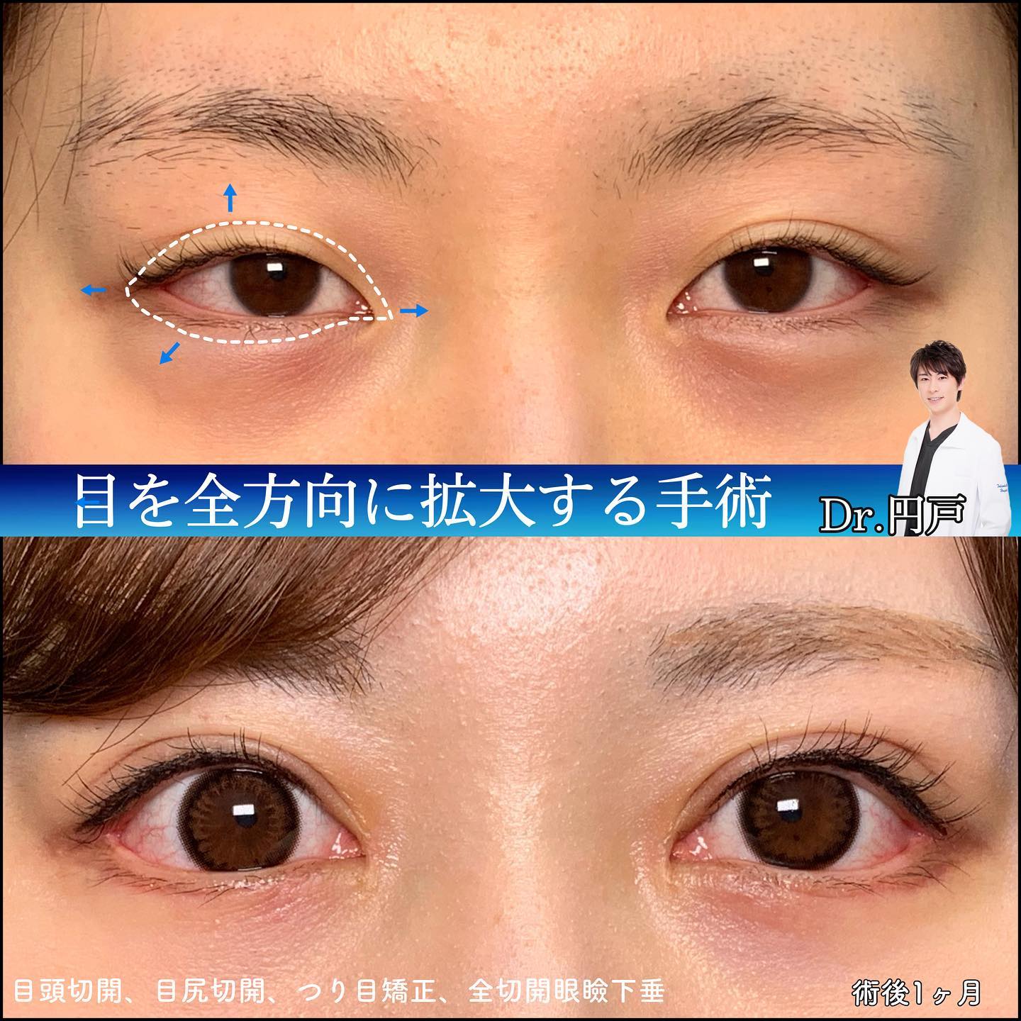 全切開で目を全方位拡大した症例写真