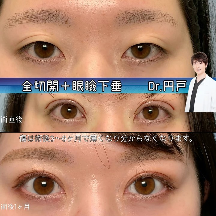 全切開と眼瞼下垂の症例写真