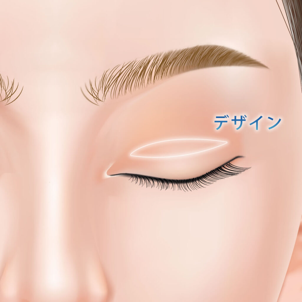 全切開のデザイン