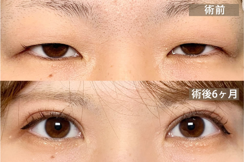 全切開（二重切開）