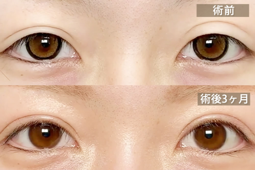 まつ毛の生え際がきれいに見せる全切開の症例