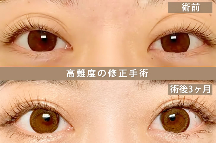 他院の全切開の失敗の修正手術の症例