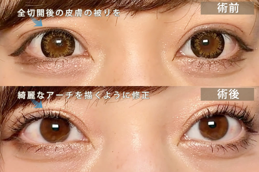 全切開の手術後の二重幅の修正の症例