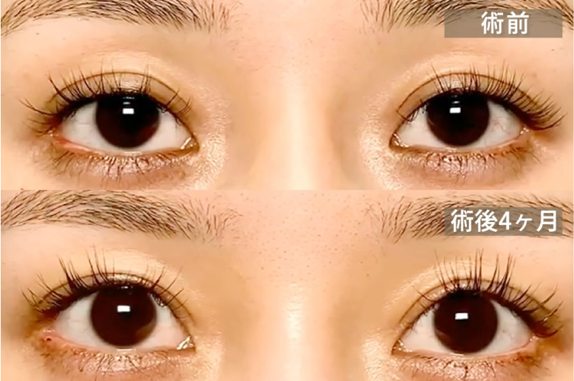眠たそうな目になってしまった状態を修正した症例