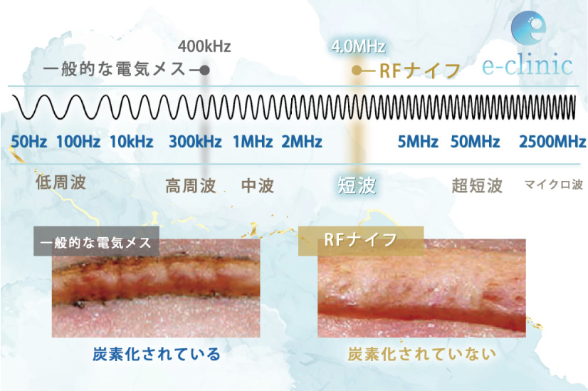 RFナイフの波長の説明